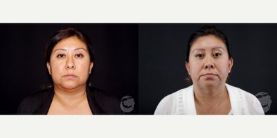 41 year old woman treated with CoolMini to the chin. - 41 year old woman treated with CoolMini to the chin. Photos depict before and 2 years after treatment.