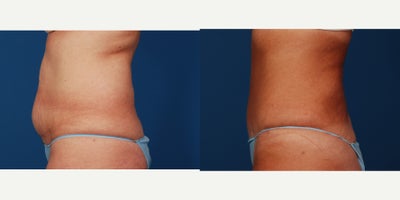 45-54 year old woman treated with Tummy Tuck - Abdominoplasty with lipo-suction to abdomen and Hips