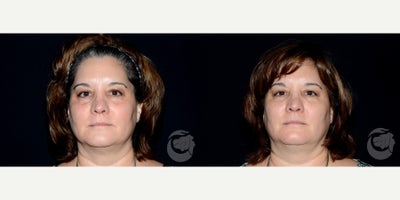 54 year old woman treated with Restylane Lyft to tear troughs - 54 year old woman treated with Restylane Lyft to tear troughs.Photos depict before and 1 month after procedure.