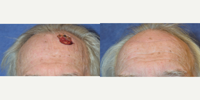 75 and up year old man treated with Scar Removal - Scar revision after MOHS surgery