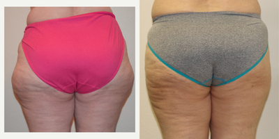 45-54 year old woman treated with Liposculpture of outer thighs (saddle bags). - This is a 54 year-old female with a chief complaint of an abnormal shape of her outer thighs. The patient is healthy and she eats a well-balanced diet. She exercises moderately. Despite weight loss and exercise throughout her adult years, she continues to have this unflattering lipodystrophy (abnormal distribution of fat). She underwent suction-assisted liposuction to the outer thigh area. This patient had an uneventful recovery. She experienced typical mild discomfort for 10-14 days as well as mild bruising and swelling. She was required to wear a post-operative compression garment for one month following surgery. The fat located in the outer thigh area is typically easy to remove using any liposuction device (e.g.,suction-assisted, power-assisted, ultrasonic, water-jet) relative to some other areas of the body, where the fat is more fibrotic.