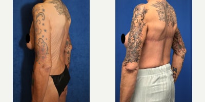 Horizontal Back Lift After Massive Weight Loss | Torsoplasty Transformation - At 65 years old, our patient is a White female who had lost over 100lbs and was left with significant, sagging back skin that would not tighten with exercise. At 115 lbs, her concern was no longer weight loss; it was the uncomfortable back roll and loose tissue that can bunch in bras, and make the upper torso appear heavier than it truly is. Dr. Timothy Katzen recommended a torsoplasty, also called a back lift, using a horizontal incision to remove the hanging skin and restore a smoother, more balanced contour down through the mid-back. Under general anesthesia, Dr. Katzen carefully marked the excess tissue. At the same time, the patient was positioned to show where the skin naturally folds, then a planned horizontal incision was created so the scar could be placed in a discreet location whenever possible. The loose skin and underlying fatty tissue were then removed in a controlled, even manner, with a focus on maintaining a smooth back and avoiding a pulled appearance. In total, Dr. Katzen removed 1.5 lb of excess skin and then tightened and redraped the remaining tissue to improve contour and reduce bulging along the sides of the torso. The incision was closed in multiple layers to promote strong healing, and compression is typically used to reduce swelling and maintain the new contour. These photos were taken 2.5 months after surgery, and her results are already remarkable, showing a flatter back profile and a more defined, youthful torso silhouette, with continued healing refining these features.