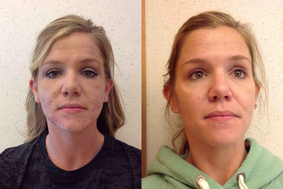 Accutane - Acne treatment