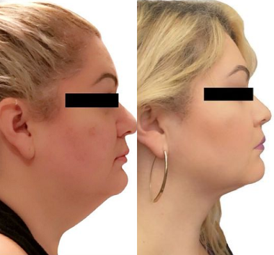 Woman treated with Chin Liposuction - Woman treated with Chin Liposuction