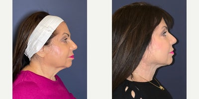 65-74 year old woman treated with Nonsurgical Neck Lift - MyEllevate - Description: Female patient after MyEllevate ~ Age 73 Highlights: Notice the improvement in her neck line after this minimally invasive procedure.