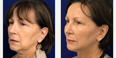 65-74 year old woman treated with Liquid Facelift - Liquid Facelift on my 70 years young patient. I used Restylane classic to plump her lips, Restylane Defyne in the nasolabial folds & marionette lines to soften & reduce the deep creases, Restylane Lyft in her cheeks to restore facial volume & to also lift the lower part of the face (jawline) and last but not least Dysport to address fine lines. 2 weeks post treatment, she is extremely happy with her rejuvenated appearance!