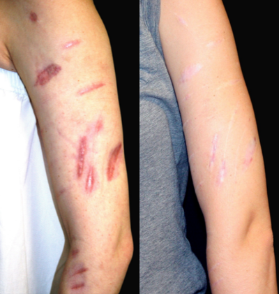 18-24 year old woman treated with Vbeam - The Candela Vbeam produces an intense, but gentle, burst of light that selectively destroys the blood vessels of your spider veins, without damaging the surrounding tissue. After laser treatment the surrounding tissue is left intact. The Vbeam can also treat rosacea, leg veins, scars, warts, stretch marks, hemangiomas, and red birthmarks. It does so quickly and conveniently with virtually no pain.