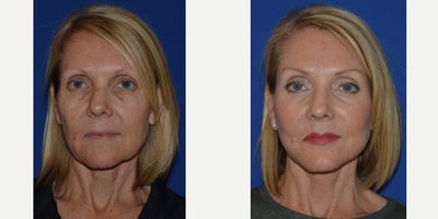 55-64 year old woman treated with Facelift - Lateral SMASectomy facelift with platysmaplasty neck lift.