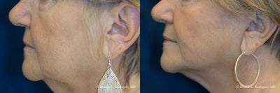 Lower Face Lift - 65-74 year old woman treated with Lower Face Lift