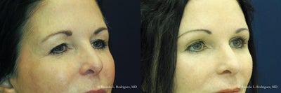 Brow Lift - 55-64 year old woman treated with Brow Lift