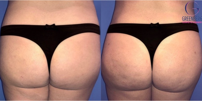 Woman treated with Liposuction, Butt Lift, Butt Augmentation, Brazilian Butt Lift - A fat transfer can fill an area of your body with volume that looks and feels natural. Notice the patient newly contoured flanks. The simple procedure can provide significant body contouring for an enhanced figure.