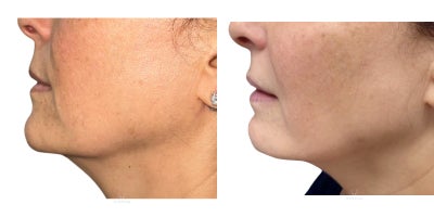 55-64 year old woman treated with Skin Tightening, Endolift - Full face slimming and lower face contouring.