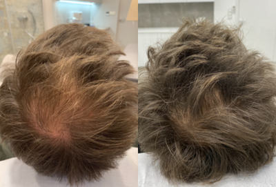 25-34 year old man treated with Mesotherapy - Scalp mesotherapy treatment.