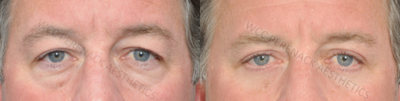 45-54 year old man treated with Eyelid Surgery - Eyelid surgery or blepharoplasty can correct sagging eyelids, remove fatty pouches beneath the eyes and remove excess skin from the upper eyelids. Blepharoplasty can be done alone or with other facial procedures. This patient had an Upper & Lower Blepharoplasty with Canthopexy.