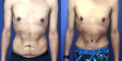 18-24 year old man treated with Male Tummy Tuck - An man in his 20s is shown 1 month after a short incision Tummy Tuck. Prior to surgery, the patient had lost a significant amount of weight with diet and exercise, but still had excess skin in his abdomen, both above and below the belly button, that could only be treated with a Tummy Tuck. A scar minimizing technique provided a short waistline incision well hidden below the underwear line, and a special belly button technique was utilized to provide no visible scar on the external skin.
