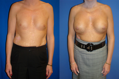 Breast Augmentation Surgery - This 46-year old patient from Guatay, California was interested in breast augmentation surgery. The patient wanted fullness of the breast, emphasis on the cleavage, and overall a natural look. In order to achieve her desired look, saline breast implants was used, filled to 500cc in both breasts, made by Mentor Corporation.