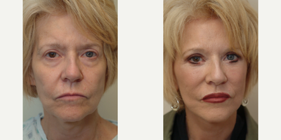 55-64 year old woman treated with Cheek Lift - Cheek Lift, Miniface Lift and Lower Eyelid Bag Treatment