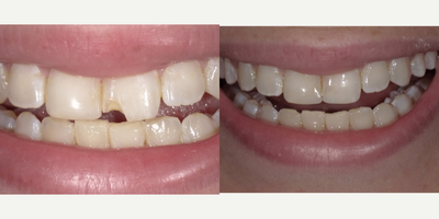 25-34 year old woman treated with Tooth Repair, Dental Bonding - Patient presented frantic as she had an interview scheduled for later that day as she fractured her front central incisor earlier that morning. Dr. D got her in and did his magic with cosmetic bonding using ceramic resin composite to restore the form, function and aesthetics of her smile.