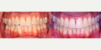 45 year old man treated with Invisalign - 45 year old male presented with a chief complaint of an uneven smile, his upper front teeth overlap and a lower front tooth sticking out in front of all the other teeth. He also complained of difficulty keeping his teeth clean due to the heavy crowding. Invisalign treatment was completed in just over one year.
