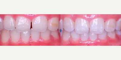 Woman treated with Invisalign - Patient presented with a chief complaint of mild relapse of upper front teeth spacing and lower front teeth mild crowding. Clear aligner therapy was completed in 2 months followed by a fixed back of the teeth retainer to help avoid future relapse and aid in keeping the newly straightened teeth aligned.