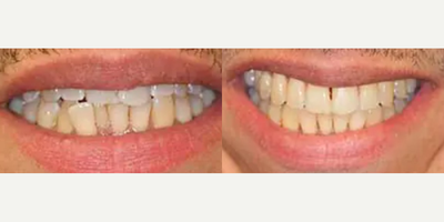 45 year old man treated with Invisalign - 45 year old male presented with a chief complaint of an uneven smile, his upper front teeth overlap and a lower front tooth sticking out in front of all the other teeth. He also complained of difficulty keeping his teeth clean due to the heavy crowding. Invisalign treatment was completed in just over one year.