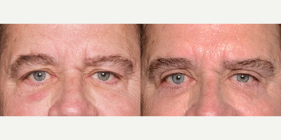 Man in his 60s treated with Double Eyelid Surgery - Man in his 60s treated with Double Eyelid Surgery