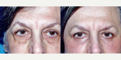 Woman treated with Laser Resurfacing - Woman treated with lower Eyelid Surgery and Laser Resurfacing