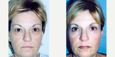 Woman treated with Laser Resurfacing - Woman treated with Eyelid Surgery and Laser Resurfacing