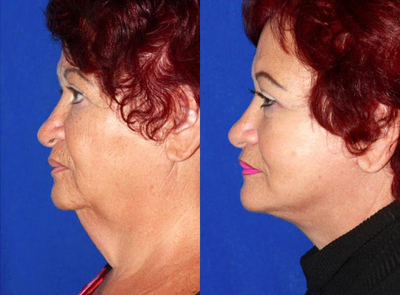 Woman treated with Neck Lift - Woman treated with Neck Lift and Facelift