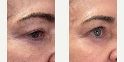 65-74 year old woman treated with Halo Laser, ProFractional Laser - HALO and ProFractional laser treatments performed at 8 West Clinic, Vancouver, BC