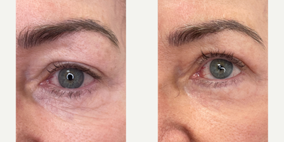 65-74 year old woman treated with Halo Laser, ProFractional Laser - HALO and ProFractional laser treatments performed at 8 West Clinic, Vancouver, BC