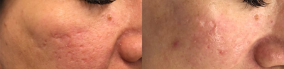 Woman treated with Vivace - Woman treated with Vivace