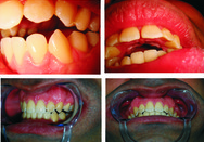 Invisalign - Patients who suck their thumbs as children can develop disfiguring open bites. We treated this gentleman by removing 2 upper premolar teeth and using Invisalign to bring the front teeth down and inwards.