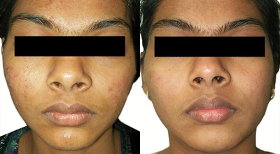 Venus Viva - Before and After 7 Treatments. &nbsp;Photos provided courtesy of Venus Concept, performed by Megha Joy Shah, MD.