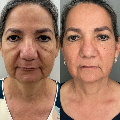 55-64 year old woman treated with Morpheus8 - MORPHEUS 8 BURST FACE AND NECK