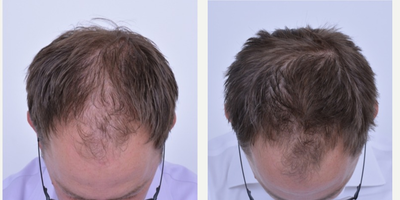 25-34 year old Male Treated His Hair Loss with Low-level Laser Therapy - 9 month Results - Patient is a male in his 30s, classified as a Norwood IIIv in April 2014. Patient decided to use low-level laser therapy as his hair loss prevention. After 9 months (4/2014 to 1/2015) of using LLLT every other day for 30 minutes.