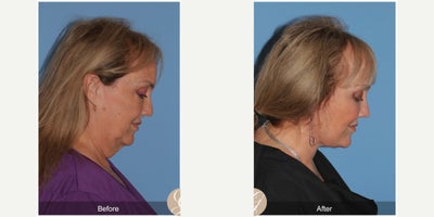 66 year old woman treated with Deep Plane Facelift, Neck Lift, Eyelid Surgery, CO2 Laser, MACS Facelift - 66 year old woman treated with Deep Plane Face and Neck Lift, Lower Blepharoplasty, CO2 Laser ofFace, MAC