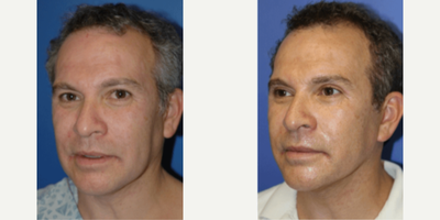 Man treated with Facelift - Man treated with Facelift