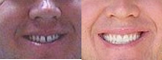 Porcelain Veneers - Before and after porcelain veneers.