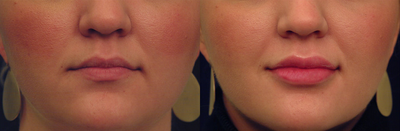 Restylane - Restylane on upper and lower lips.