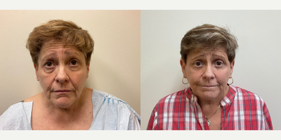 Woman treated with Facelift, Eyelid Surgery - Woman treated with Facelift, Eyelid Surgery