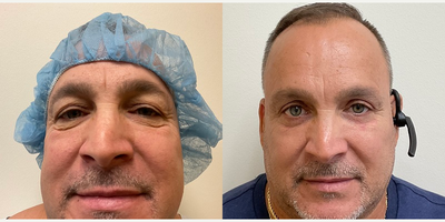 Woman treated with Eyelid Surgery - Woman treated with Eyelid Surgery