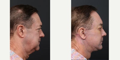 64 year old man treated with Deep Plane Face and Neck Lift, Endolift, Stem Cell Facial Fat Transfer, Submentoplasty, and Lower B - Deep Plane FaceNeck LiftEndoliftStem Cell Facial Fat TransferSubmentoplastyLower Blepharoplasty.