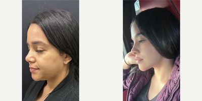 25-34 year old woman treated with Chin Liposuction, Buccal Fat Removal - 32 y.o female who underwent facial slimming surgery which includes chin liposuction and buccal fat removal.She was awake yet comfortable for the procedure