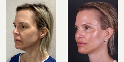 55-64 year old woman treated with Facelift, Neck Lift, Brow Lift, Ptosis Surgery, Eyelid Surgery - 55-64 year old woman treated with Facelift, Neck Lift, Brow Lift, Ptosis Surgery, Eyelid Surgery