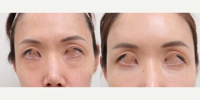 45-54 year old woman treated with Nonsurgical Facelift - To address facial volume loss and soften overall facial lines, a minimally invasive, non-incisional lifting approach using autologous fat transfer was performed.For hollow, tired-looking under-eye areas, a non-incisional fat repositioning technique was used to restore volume and improve the transition