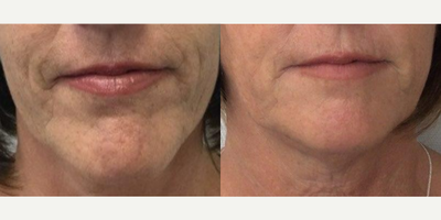 55-64 year old woman treated with Sofwave - 60 year old woman treated with Sofwave and ultherapy