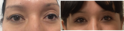 35-44 year old woman treated with Eyelid Surgery - This woman had asymmetric eyelids and brow position. We fixed this with an upper lid blepharoplasty.&nbsp;