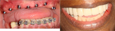 Dental Implants to replace full arch of teeth - 
	Patient originally lost all her upper teeth due to severe periodontal condition. We placed dental implants and replaced all missing teeth with a bridge.
