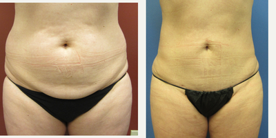 45-54 year old woman treated with Tummy Tuck - Tummy tuck with liposuction of abdomen and flanks